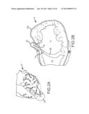 OVER-THE-WIRE CARDIAC IMPLANT DELIVERY SYSTEM FOR TREATMENT OF CHF AND     OTHER CONDITIONS diagram and image