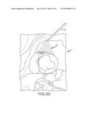 OVER-THE-WIRE CARDIAC IMPLANT DELIVERY SYSTEM FOR TREATMENT OF CHF AND     OTHER CONDITIONS diagram and image