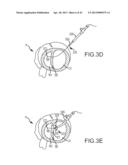 OVER-THE-WIRE CARDIAC IMPLANT DELIVERY SYSTEM FOR TREATMENT OF CHF AND     OTHER CONDITIONS diagram and image