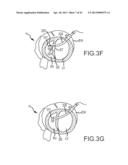 OVER-THE-WIRE CARDIAC IMPLANT DELIVERY SYSTEM FOR TREATMENT OF CHF AND     OTHER CONDITIONS diagram and image