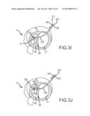 OVER-THE-WIRE CARDIAC IMPLANT DELIVERY SYSTEM FOR TREATMENT OF CHF AND     OTHER CONDITIONS diagram and image