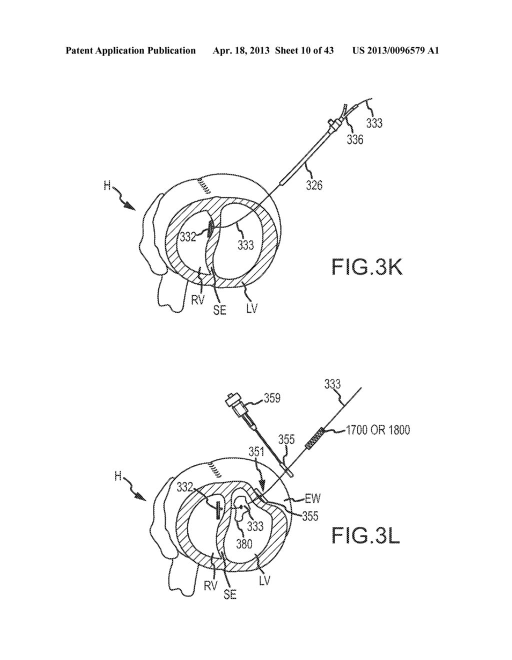 OVER-THE-WIRE CARDIAC IMPLANT DELIVERY SYSTEM FOR TREATMENT OF CHF AND     OTHER CONDITIONS - diagram, schematic, and image 11