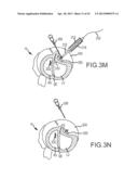 OVER-THE-WIRE CARDIAC IMPLANT DELIVERY SYSTEM FOR TREATMENT OF CHF AND     OTHER CONDITIONS diagram and image