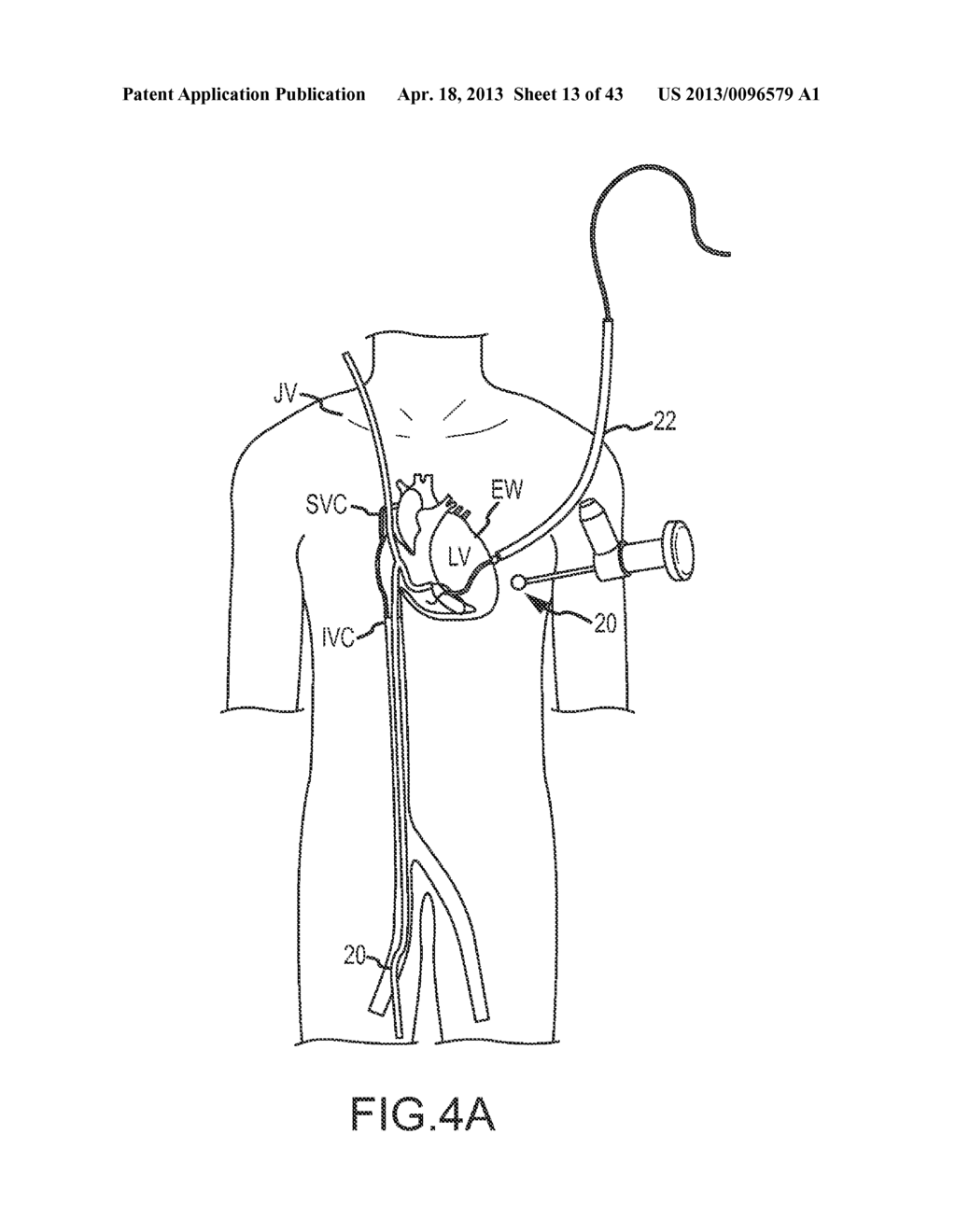 OVER-THE-WIRE CARDIAC IMPLANT DELIVERY SYSTEM FOR TREATMENT OF CHF AND     OTHER CONDITIONS - diagram, schematic, and image 14