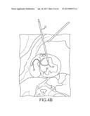 OVER-THE-WIRE CARDIAC IMPLANT DELIVERY SYSTEM FOR TREATMENT OF CHF AND     OTHER CONDITIONS diagram and image