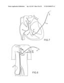 OVER-THE-WIRE CARDIAC IMPLANT DELIVERY SYSTEM FOR TREATMENT OF CHF AND     OTHER CONDITIONS diagram and image