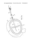 OVER-THE-WIRE CARDIAC IMPLANT DELIVERY SYSTEM FOR TREATMENT OF CHF AND     OTHER CONDITIONS diagram and image