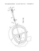 OVER-THE-WIRE CARDIAC IMPLANT DELIVERY SYSTEM FOR TREATMENT OF CHF AND     OTHER CONDITIONS diagram and image