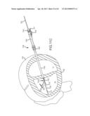 OVER-THE-WIRE CARDIAC IMPLANT DELIVERY SYSTEM FOR TREATMENT OF CHF AND     OTHER CONDITIONS diagram and image