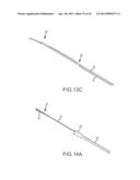 OVER-THE-WIRE CARDIAC IMPLANT DELIVERY SYSTEM FOR TREATMENT OF CHF AND     OTHER CONDITIONS diagram and image