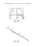 OVER-THE-WIRE CARDIAC IMPLANT DELIVERY SYSTEM FOR TREATMENT OF CHF AND     OTHER CONDITIONS diagram and image