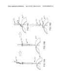 OVER-THE-WIRE CARDIAC IMPLANT DELIVERY SYSTEM FOR TREATMENT OF CHF AND     OTHER CONDITIONS diagram and image