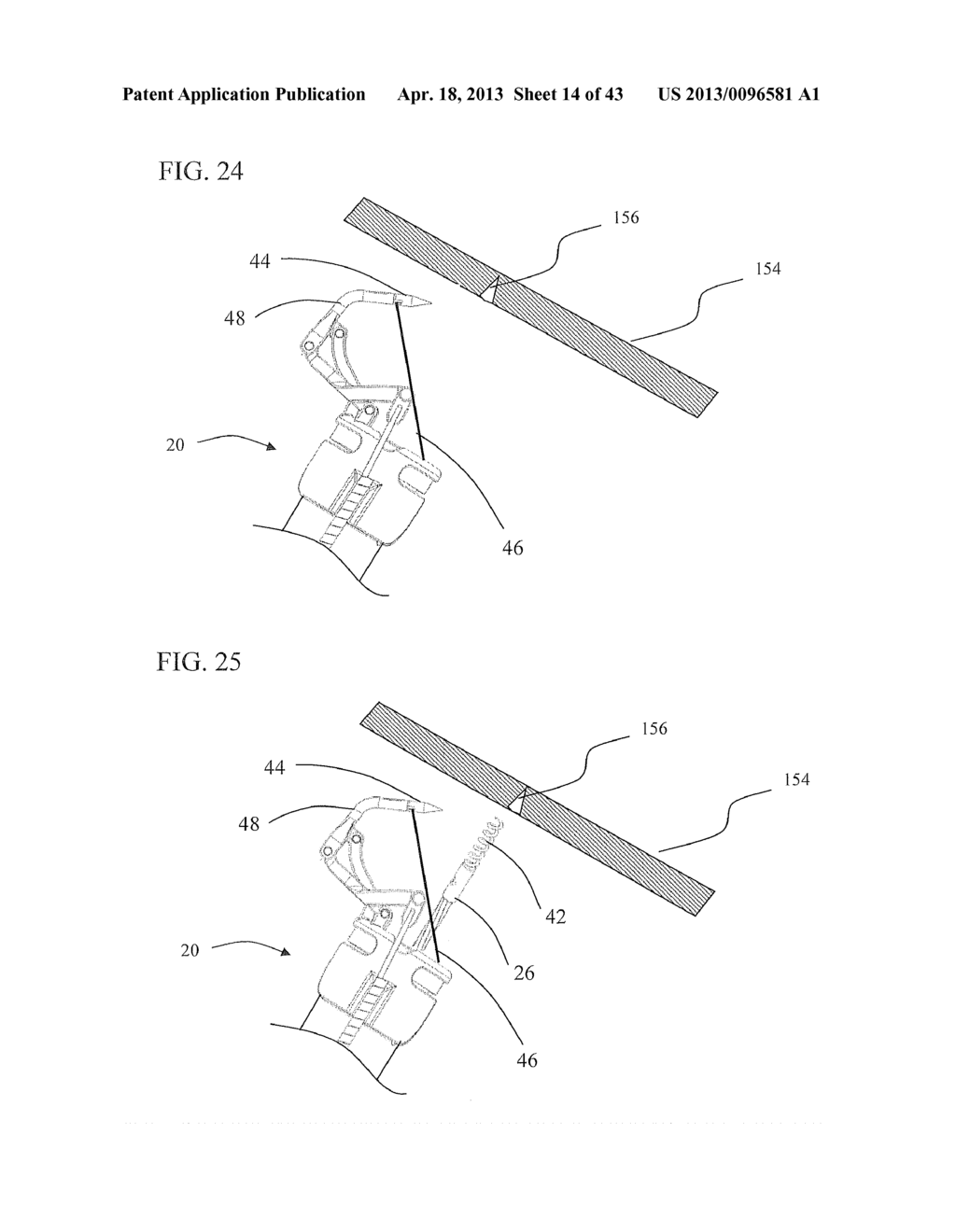 Method of endoscopic suturing - diagram, schematic, and image 15