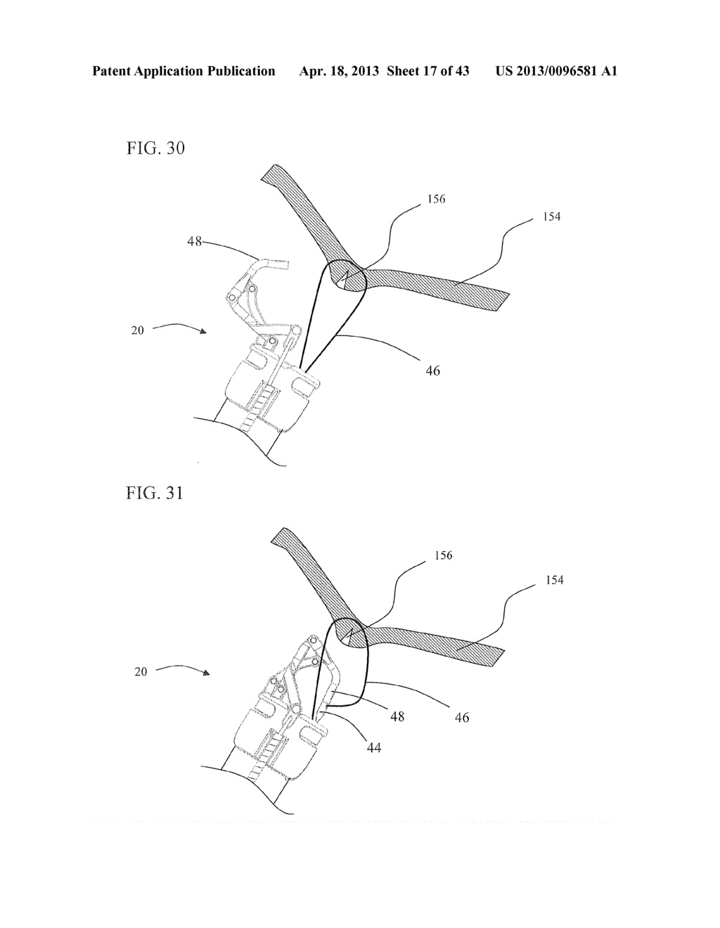 Method of endoscopic suturing - diagram, schematic, and image 18