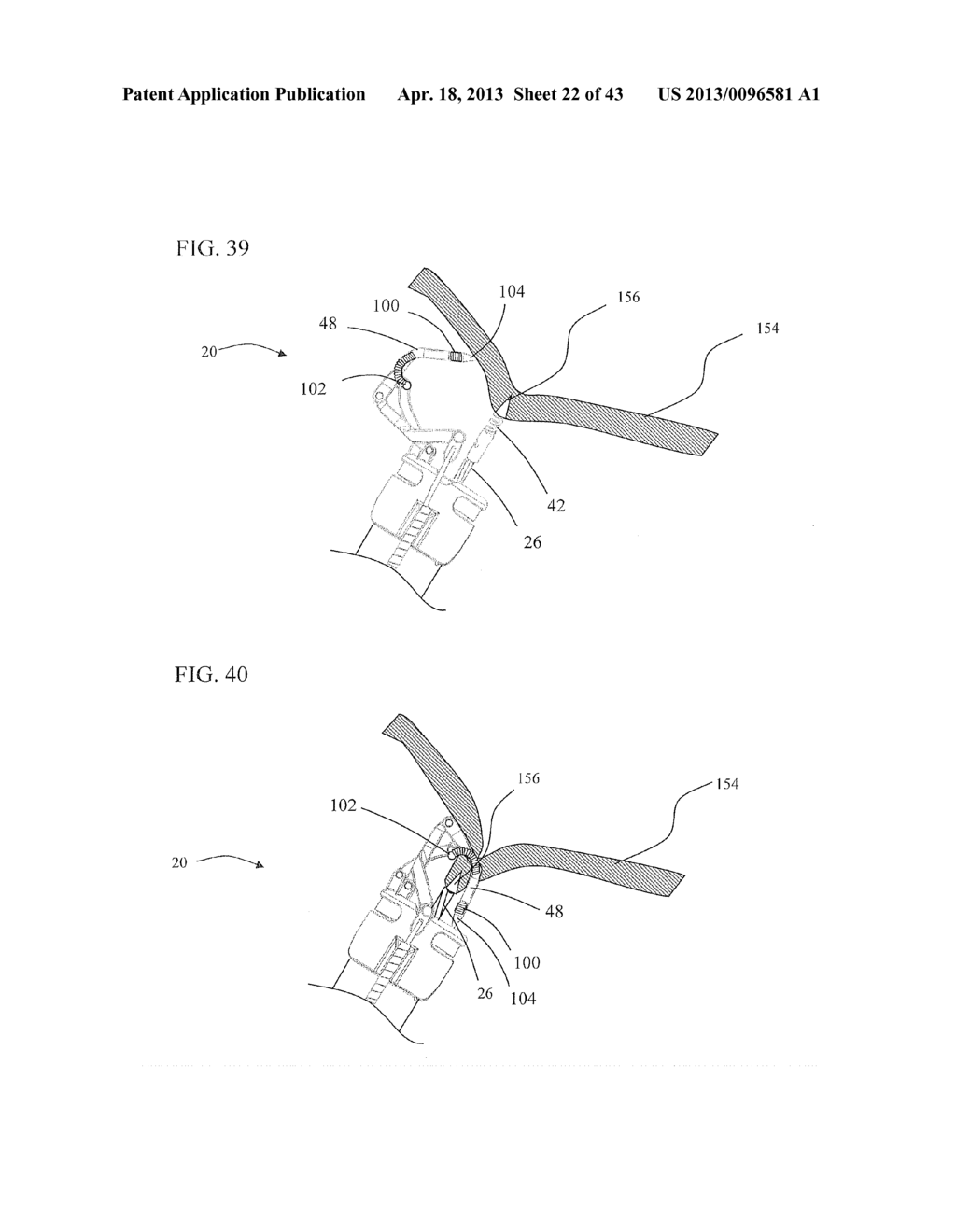 Method of endoscopic suturing - diagram, schematic, and image 23