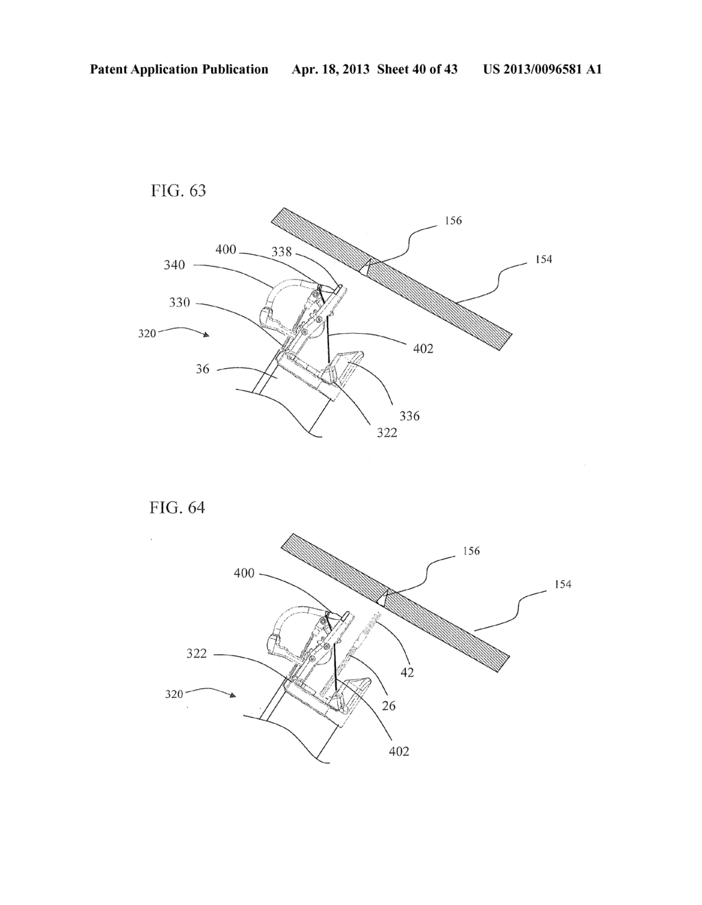 Method of endoscopic suturing - diagram, schematic, and image 41