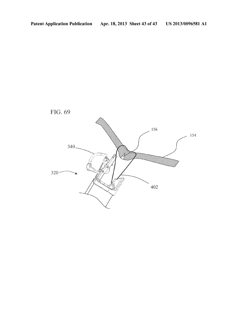 Method of endoscopic suturing - diagram, schematic, and image 44