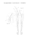 ATHERECTOMY APPARATUS, SYSTEMS AND METHODS diagram and image