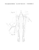 ATHERECTOMY APPARATUS, SYSTEMS AND METHODS diagram and image