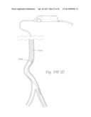 ATHERECTOMY APPARATUS, SYSTEMS AND METHODS diagram and image