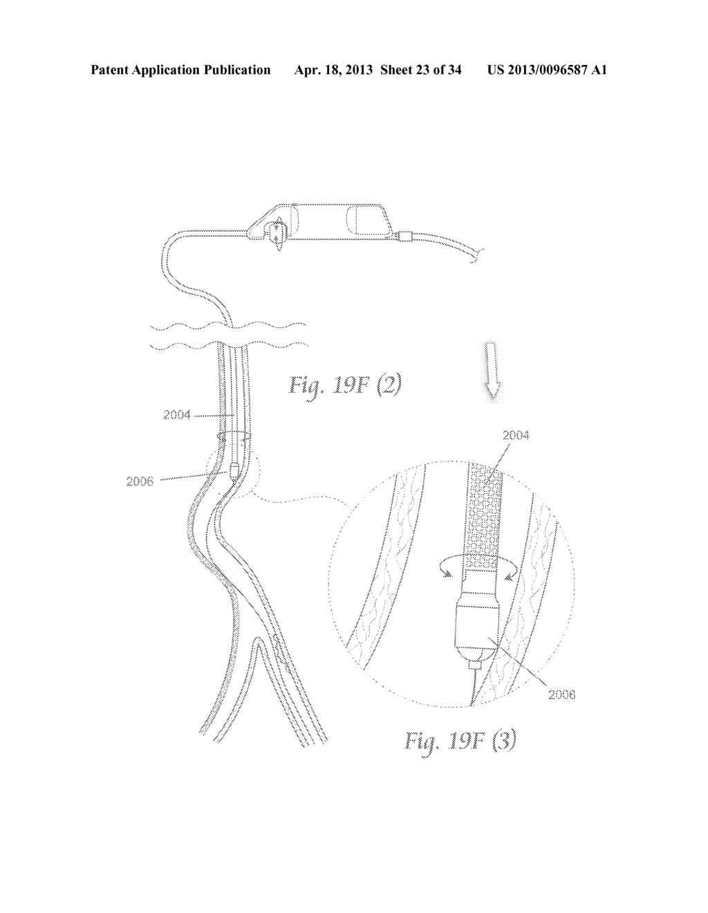 ATHERECTOMY APPARATUS, SYSTEMS AND METHODS - diagram, schematic, and image 24