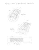 ATHERECTOMY APPARATUS, SYSTEMS AND METHODS diagram and image