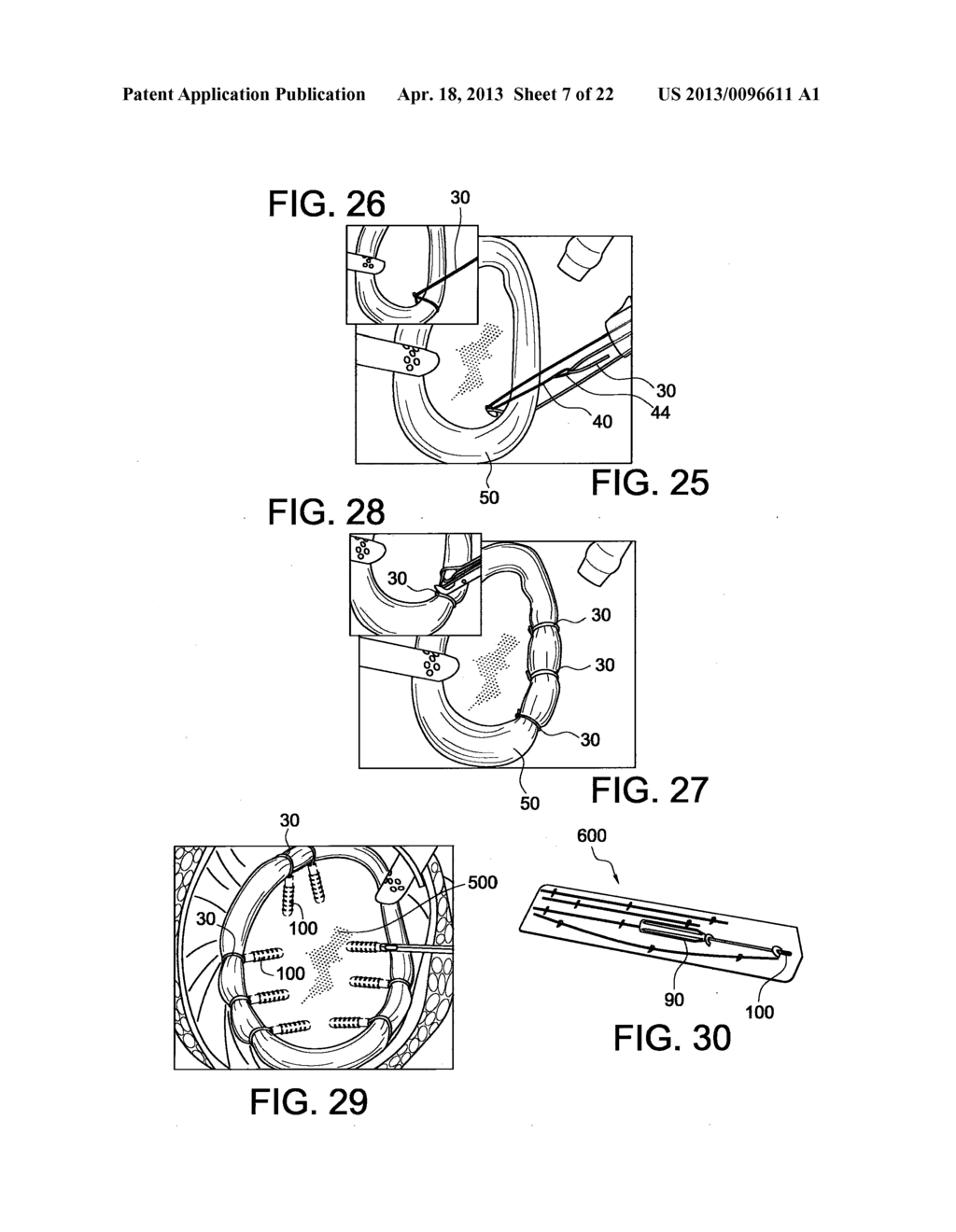 TENSIONABLE KNOTLESS ANCHORS WITH SPLICE AND METHODS OF TISSUE REPAIR - diagram, schematic, and image 08