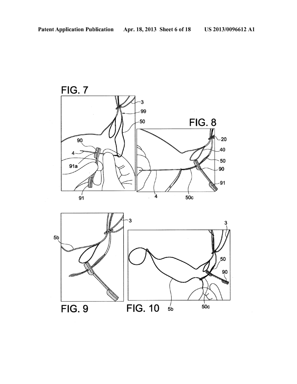 ADJUSTABLE SELF-LOCKING LOOP CONSTRUCTS FOR TISSUE REPAIRS AND     RECONSTRUCTIONS - diagram, schematic, and image 07