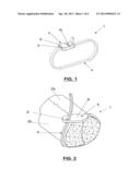 FIXATION DEVICE FOR THE FIXATION OF BONE FRAGMENTS diagram and image