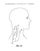 VENTRICULAR PACING diagram and image