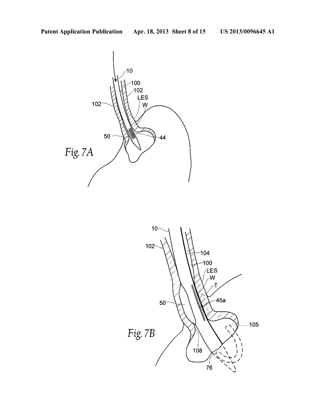 SURGICAL INSTRUMENTS AND TECHNIQUES FOR TREATING GASTRO-ESOPHAGEAL REFLUX     DISEASE - diagram, schematic, and image 09