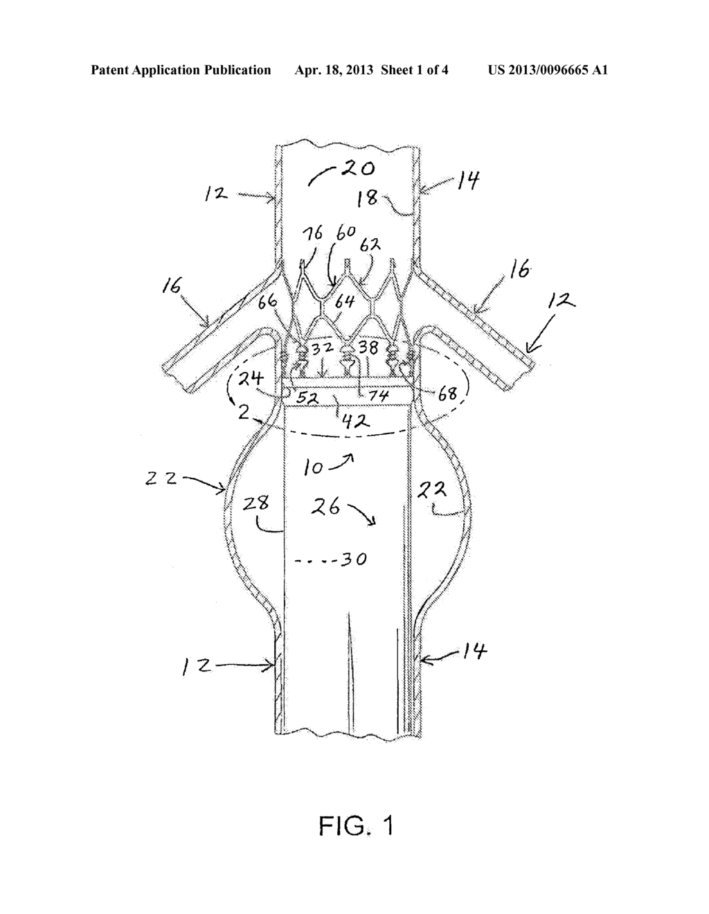 VASCULAR GRAFT HAVING LIMITED END STRUCTURE - diagram, schematic, and image 02