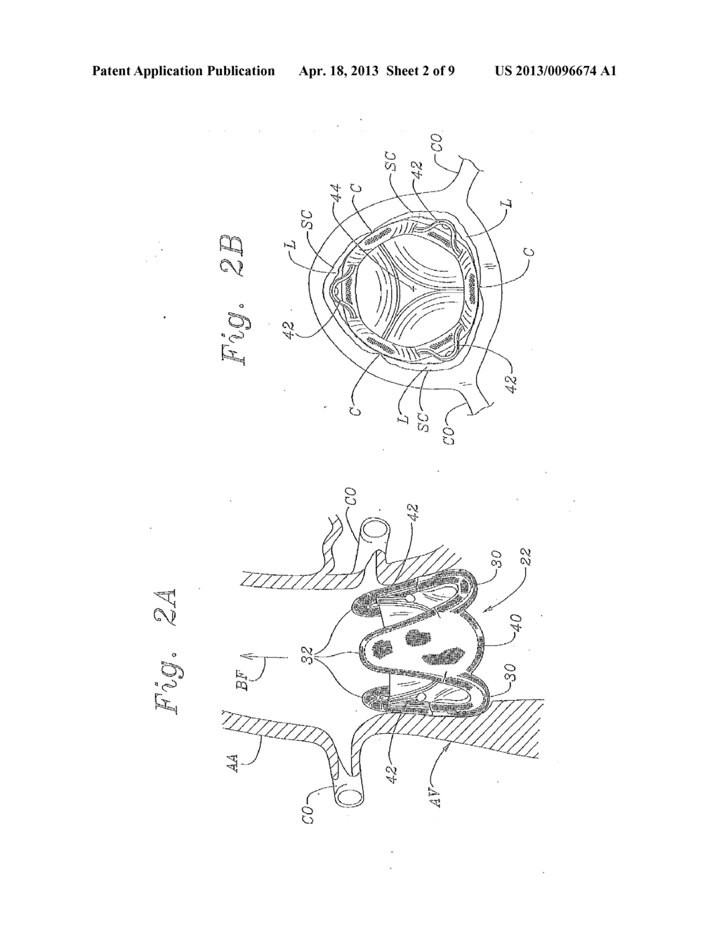 MINIMALLY-INVASIVE PROSTHETIC HEART VALVE METHOD - diagram, schematic, and image 03