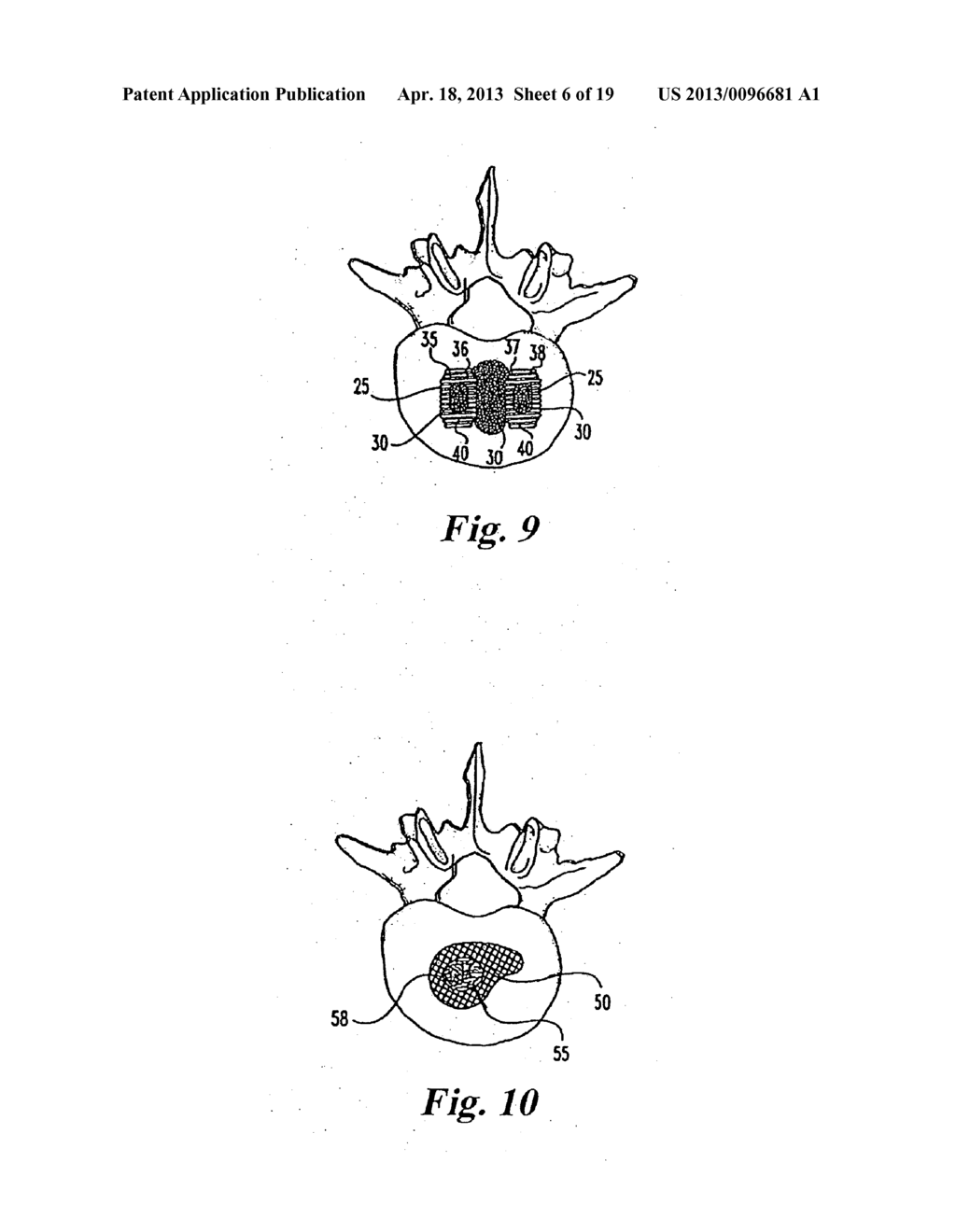 BONE GRAFTS - diagram, schematic, and image 07