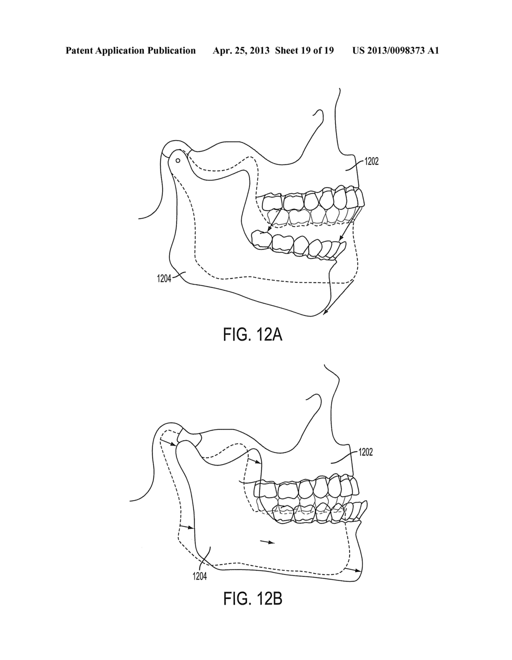 ORAL APPLIANCE AND METHODS - diagram, schematic, and image 20