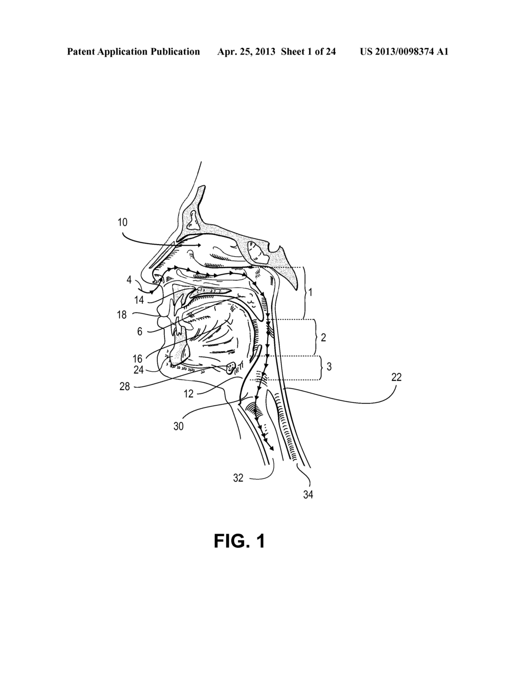 PARTIALLY ERODABLE SYSTEMS FOR TREATMENT OF OBSTRUCTIVE SLEEP APNEA - diagram, schematic, and image 02