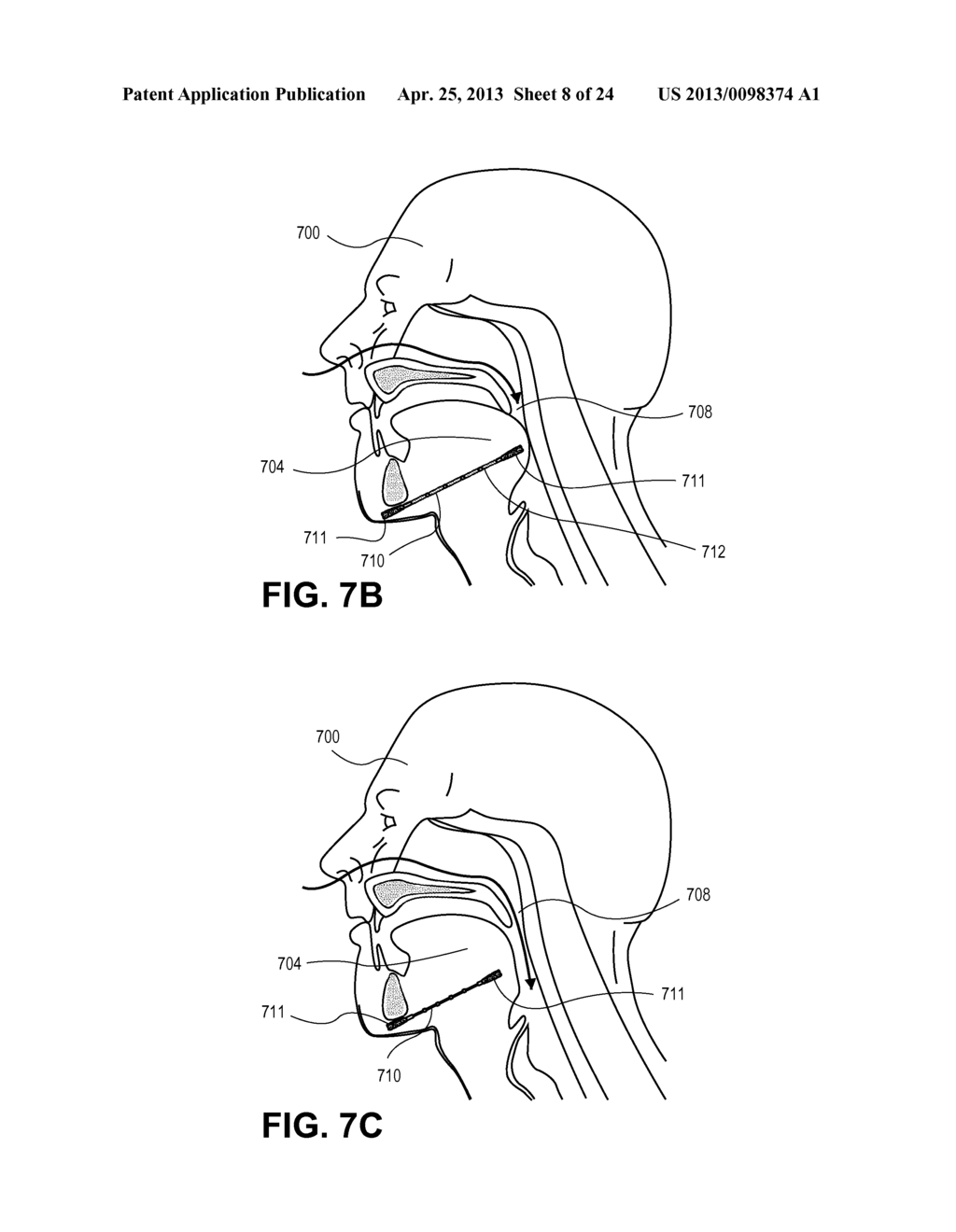 PARTIALLY ERODABLE SYSTEMS FOR TREATMENT OF OBSTRUCTIVE SLEEP APNEA - diagram, schematic, and image 09