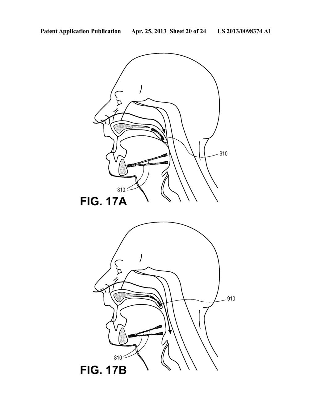 PARTIALLY ERODABLE SYSTEMS FOR TREATMENT OF OBSTRUCTIVE SLEEP APNEA - diagram, schematic, and image 21