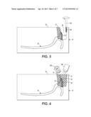 DENTURE AND METHOD AND APPARATUS OF MAKING SAME diagram and image