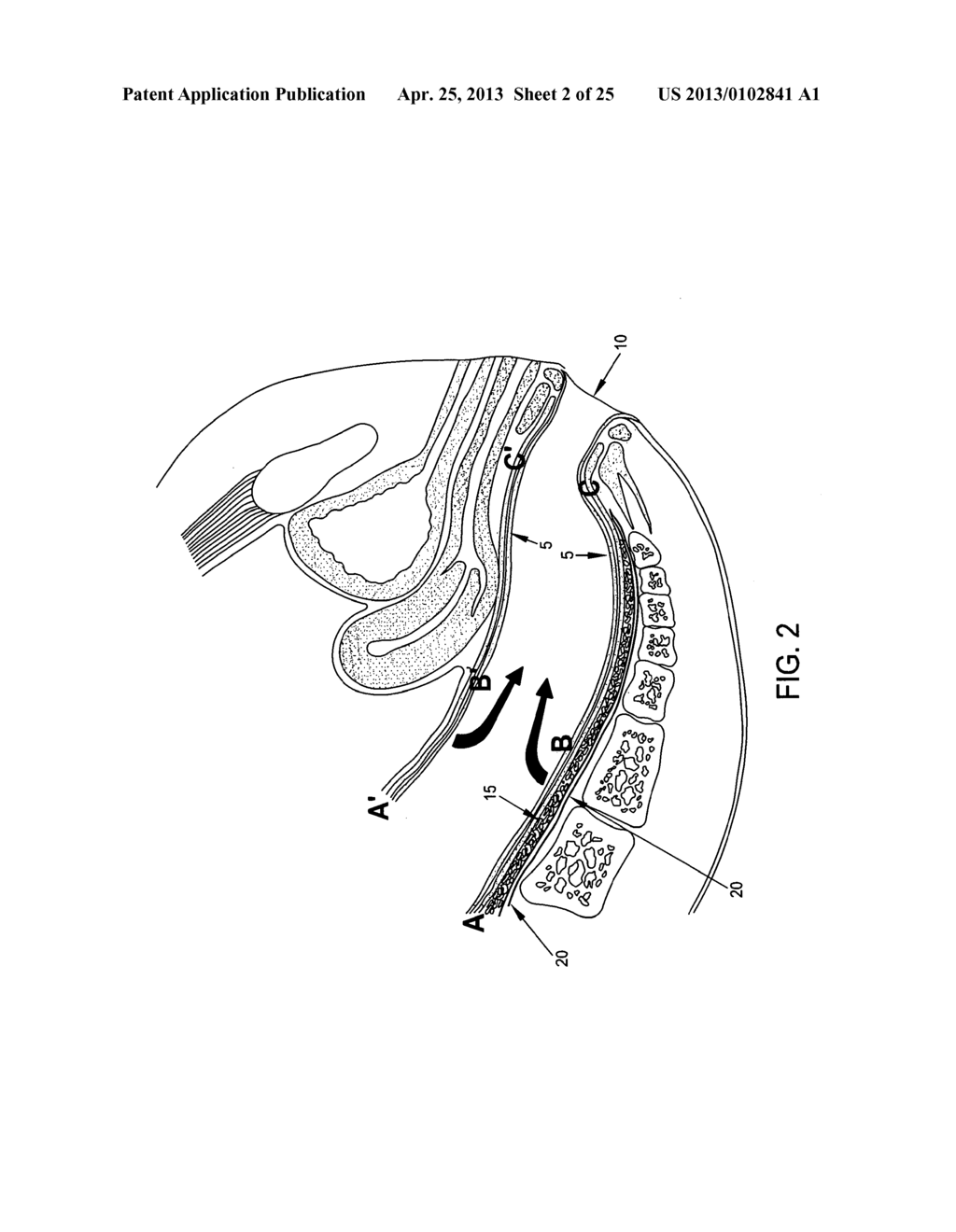 METHOD AND APPARATUS FOR ENDOSCOPICALLY TREATING RECTAL PROLAPSE - diagram, schematic, and image 03