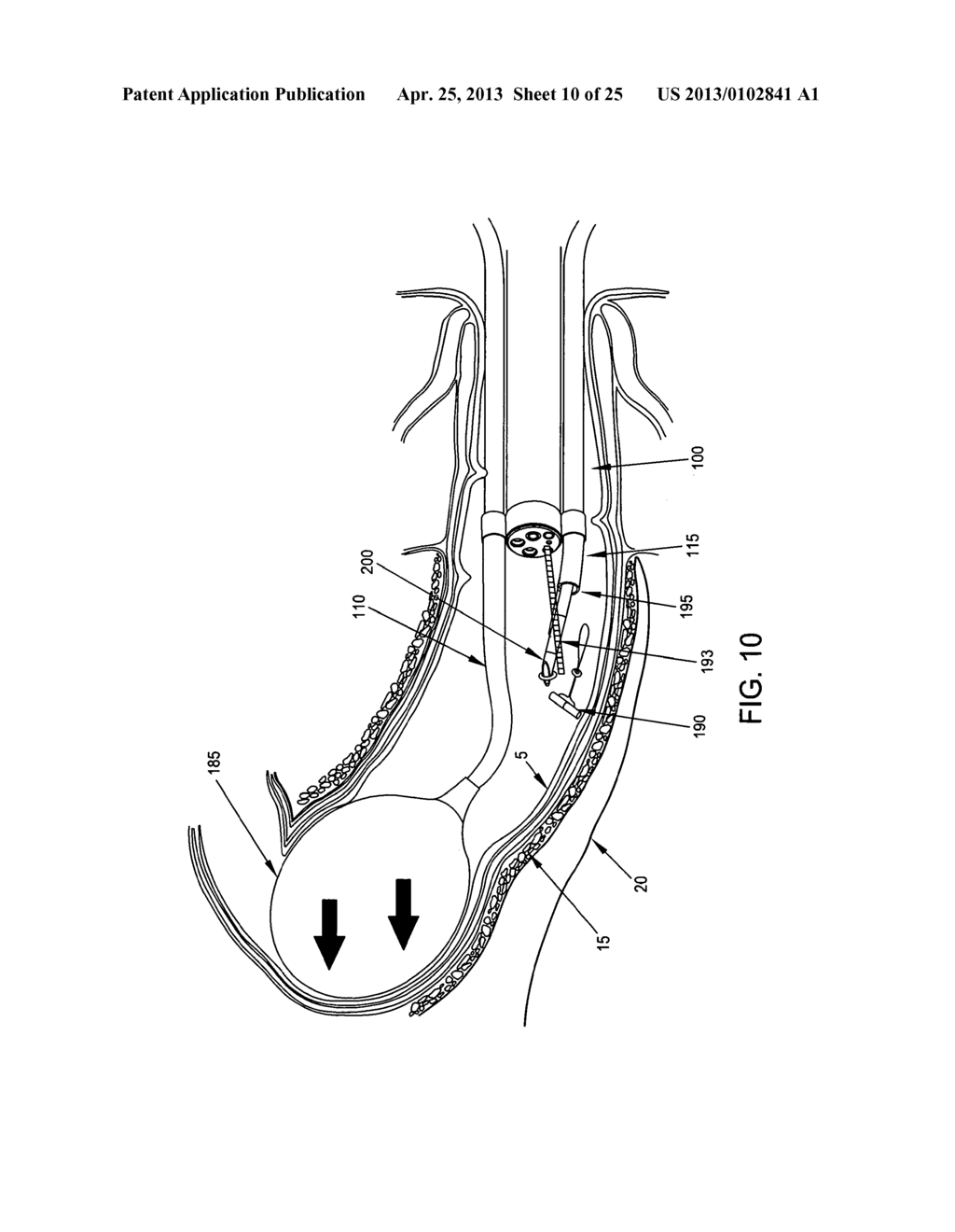 METHOD AND APPARATUS FOR ENDOSCOPICALLY TREATING RECTAL PROLAPSE - diagram, schematic, and image 11