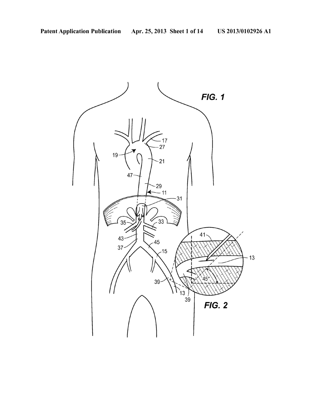 FLUOROSCOPY-INDEPENDENT, ENDOVASCULAR AORTIC OCCLUSION SYSTEM - diagram, schematic, and image 02