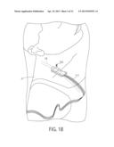 CSF SHUNT FLOW ENHANCER, METHOD FOR GENERATING CSF FLOW IN SHUNTS AND     ASSESSMENT OF PARTIAL AND COMPLETE OCCLUSION OF CSF SHUNT SYSTEMS diagram and image