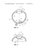 System and Method for Laser Ablation on a Surgical Surface diagram and image