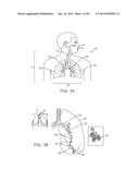 Enhanced Efficacy Lung Volume Reduction Devices, Methods, and Systems diagram and image