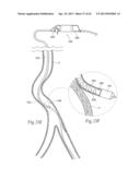 DEVICES, SYSTEMS, AND METHODS FOR PERFORMING ATHERECTOMY INCLUDING     DELIVERY OF A BIOACTIVE MATERIAL diagram and image