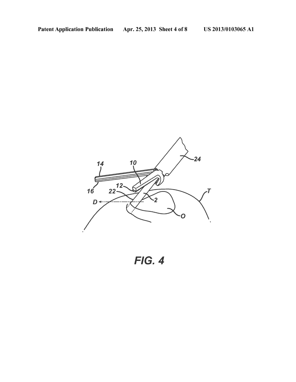 ULTRASONIC DEVICE FOR CUTTING AND COAGULATING - diagram, schematic, and image 05