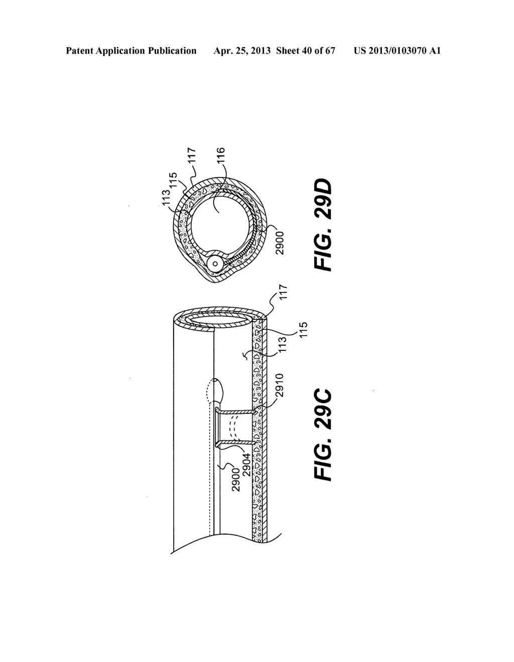 ENDOVASCULAR DEVICES AND METHODS FOR EXPLOITING INTRAMURAL SPACE - diagram, schematic, and image 41