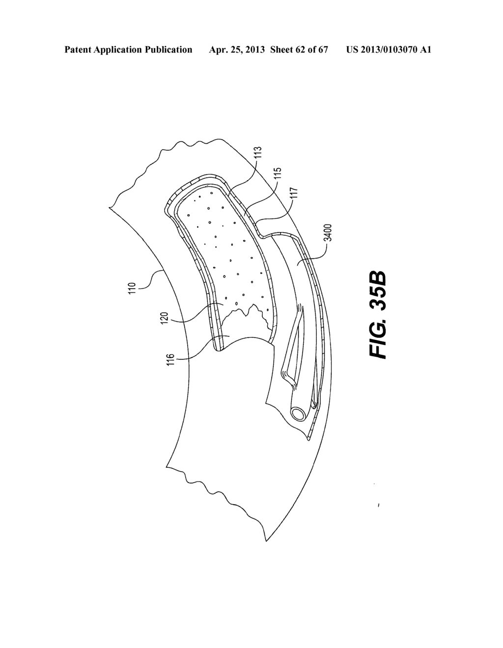 ENDOVASCULAR DEVICES AND METHODS FOR EXPLOITING INTRAMURAL SPACE - diagram, schematic, and image 63