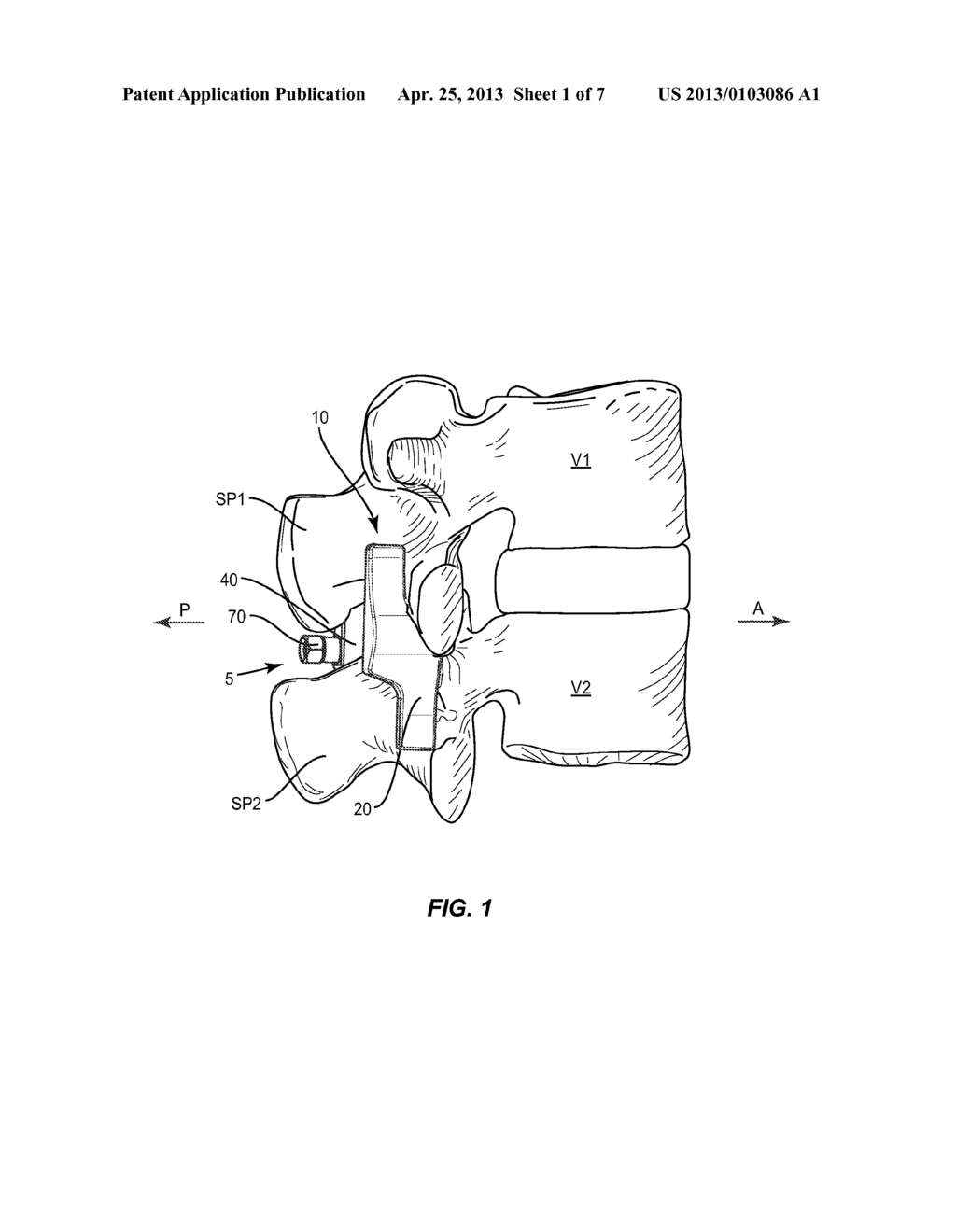 SPINOUS PROCESS MOUNTED SPINAL IMPLANT - diagram, schematic, and image 02